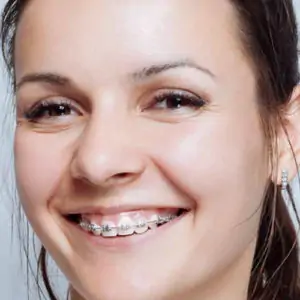 Embracing your braces know the facts