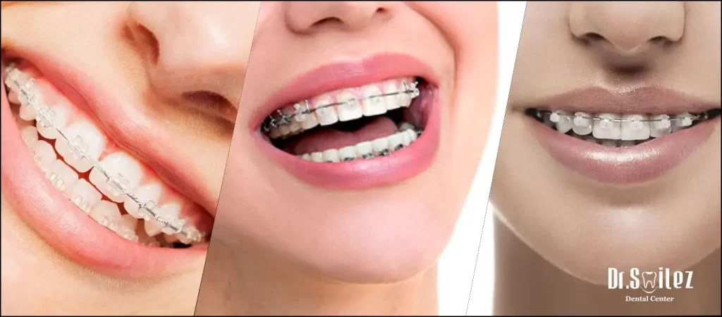 Ceramic braces cost in Chennai