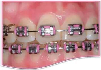 Conventional Metal Braces