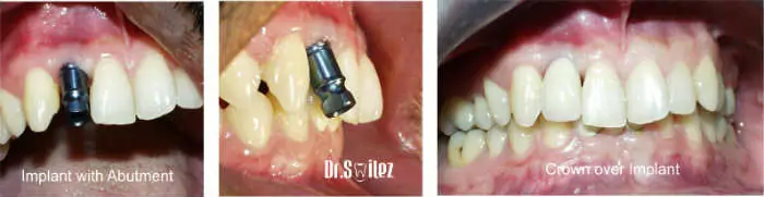 Before and After Dental Implants