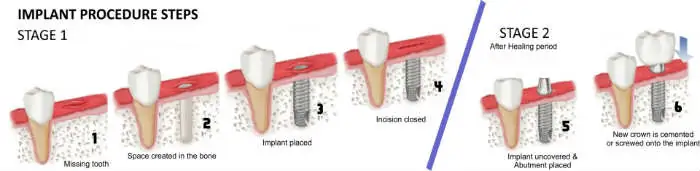 Implant Procedure