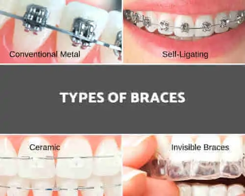 Types of Braces