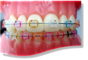 Conventional Ceramic Braces