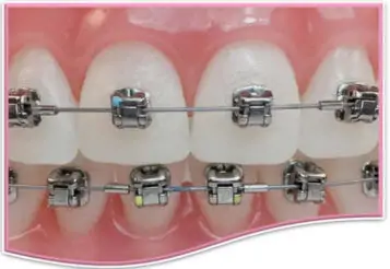 Self-Ligating Braces