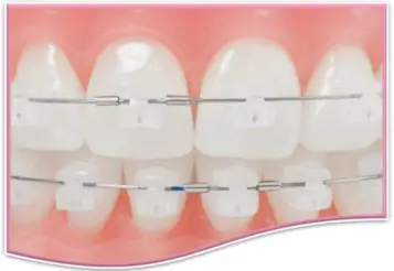 Damon Braces