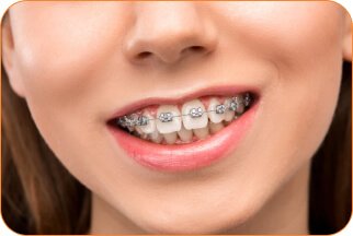 braces