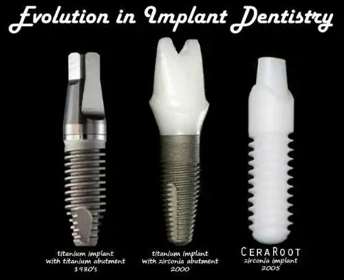 Implant Dentistry