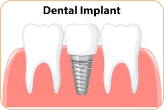 dental-implant