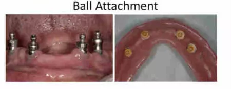 Ball Attachment