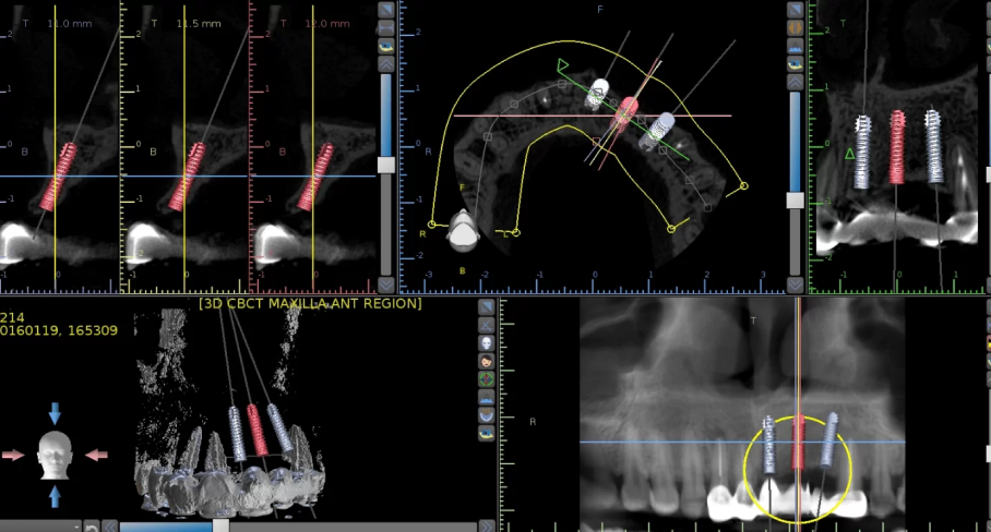 Implants Treatment Procedure
