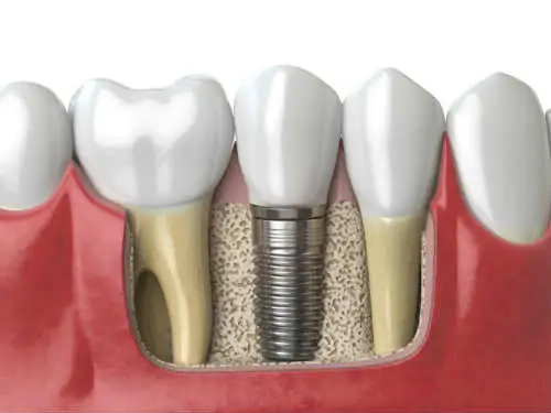 Dental Implant clinic in Chennai