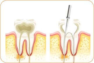 root-canal-treatment